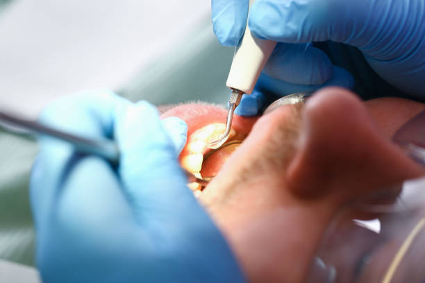Best Emergency Tooth Extraction in Icard, NC